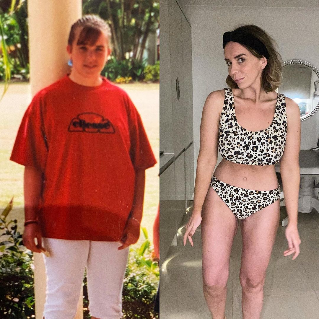 A side by side comparison of 5 steon weight loss. Holly aas a tennager on the left wearing a baggy tshirt to hide her size. On the right, holly wearing a bikkini having lost 5 stone and undergone skin remoal surgery.